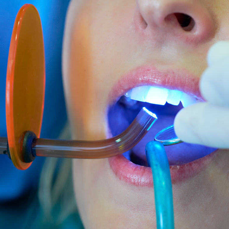 Tooth Filling Cost in Abu Dhabi: Preserving Dental Health